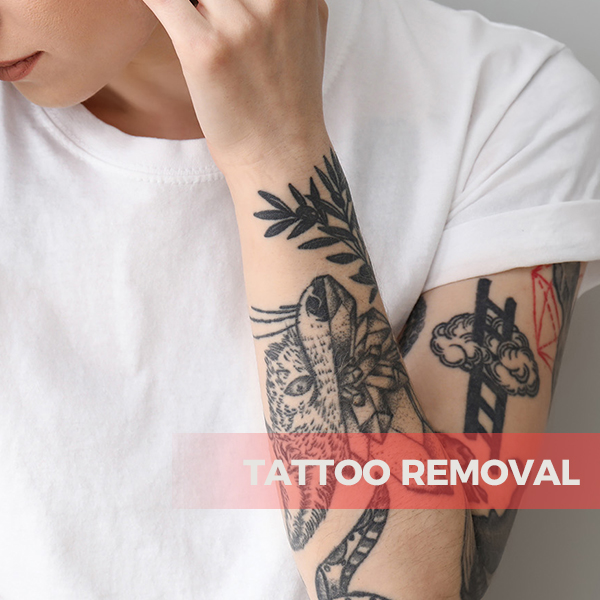 Picolaser Tattoo Removal for Full Body