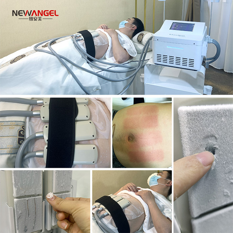 Ems Cryo Plate Machine Non-invasive Body Slimming