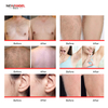 Best laser hair removal machine clinic for all skin tone